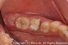 患者さまの声 親知らず 歯の移植 自家歯牙移植編 Tooth Autotransplantation 才 女性 調布市の歯医者ならあきら歯科 柴崎駅改札正面