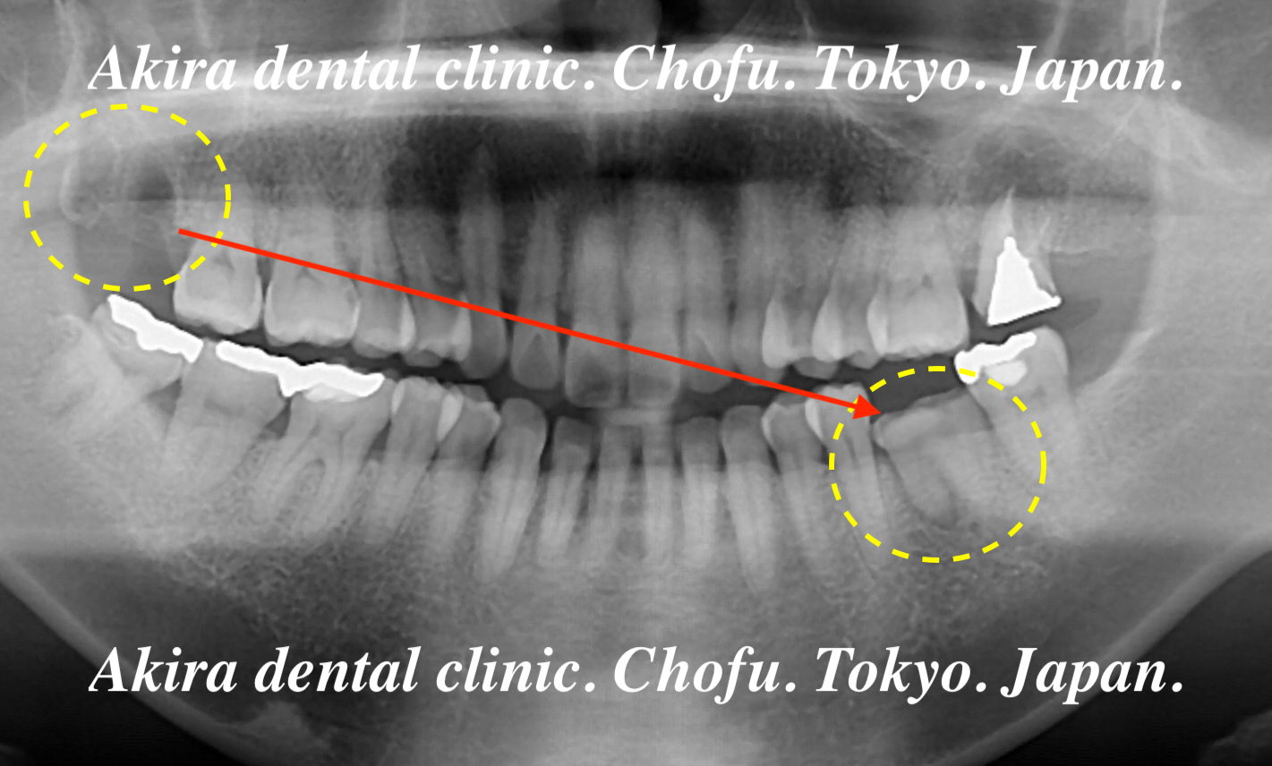 患者様の声 親知らず・歯の移植・自家歯牙移植編 Tooth