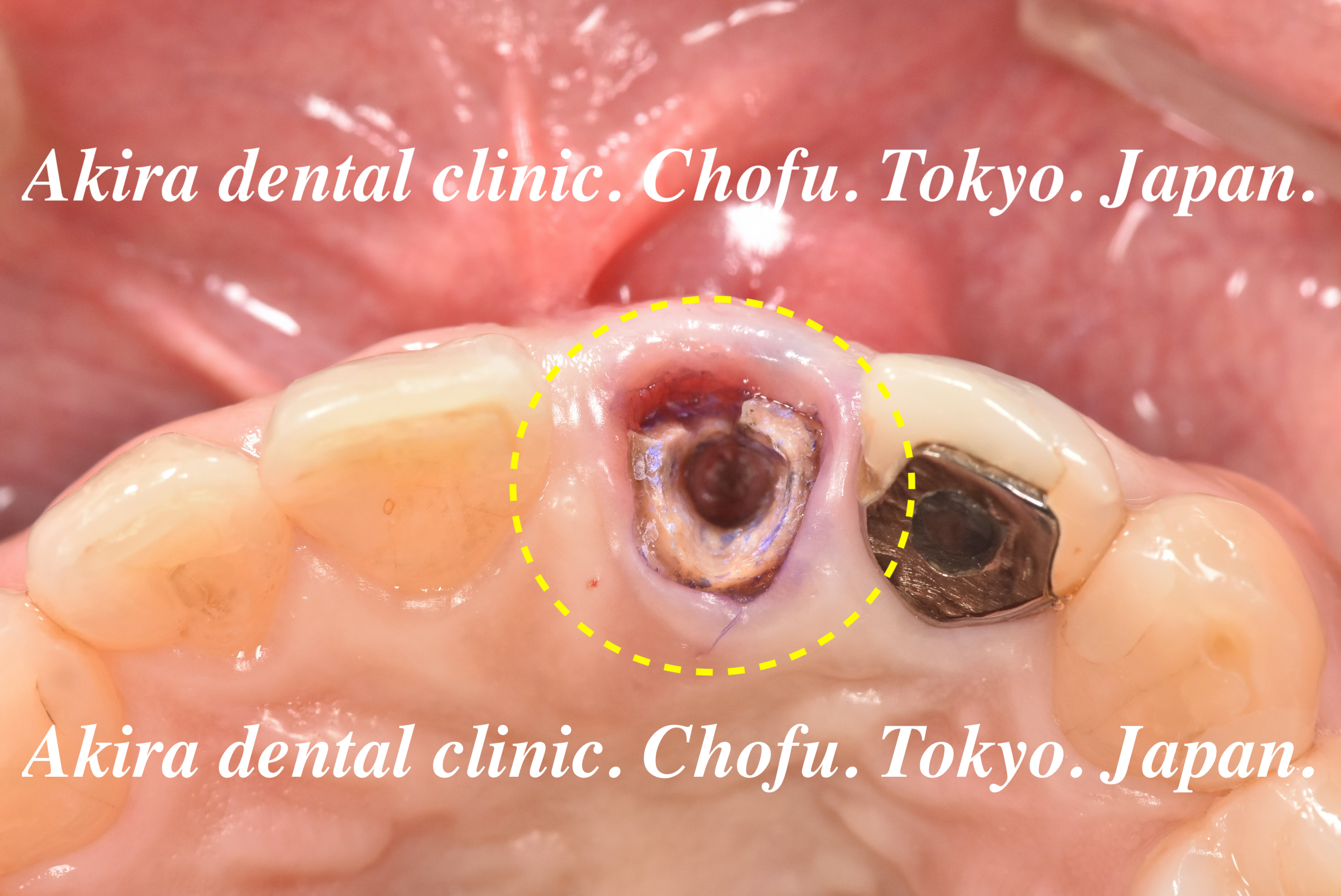 前歯部抜歯即時インプラント治療編 ( Immediate implant placement in