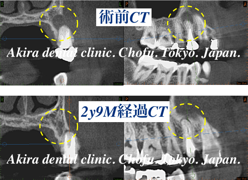 歯根嚢胞 感染根管治療編 Radicular Cyst Infected Root Canal Treatment 女性 患者様の声 調布市の歯科 歯医者ならあきら歯科 柴崎駅改札正面