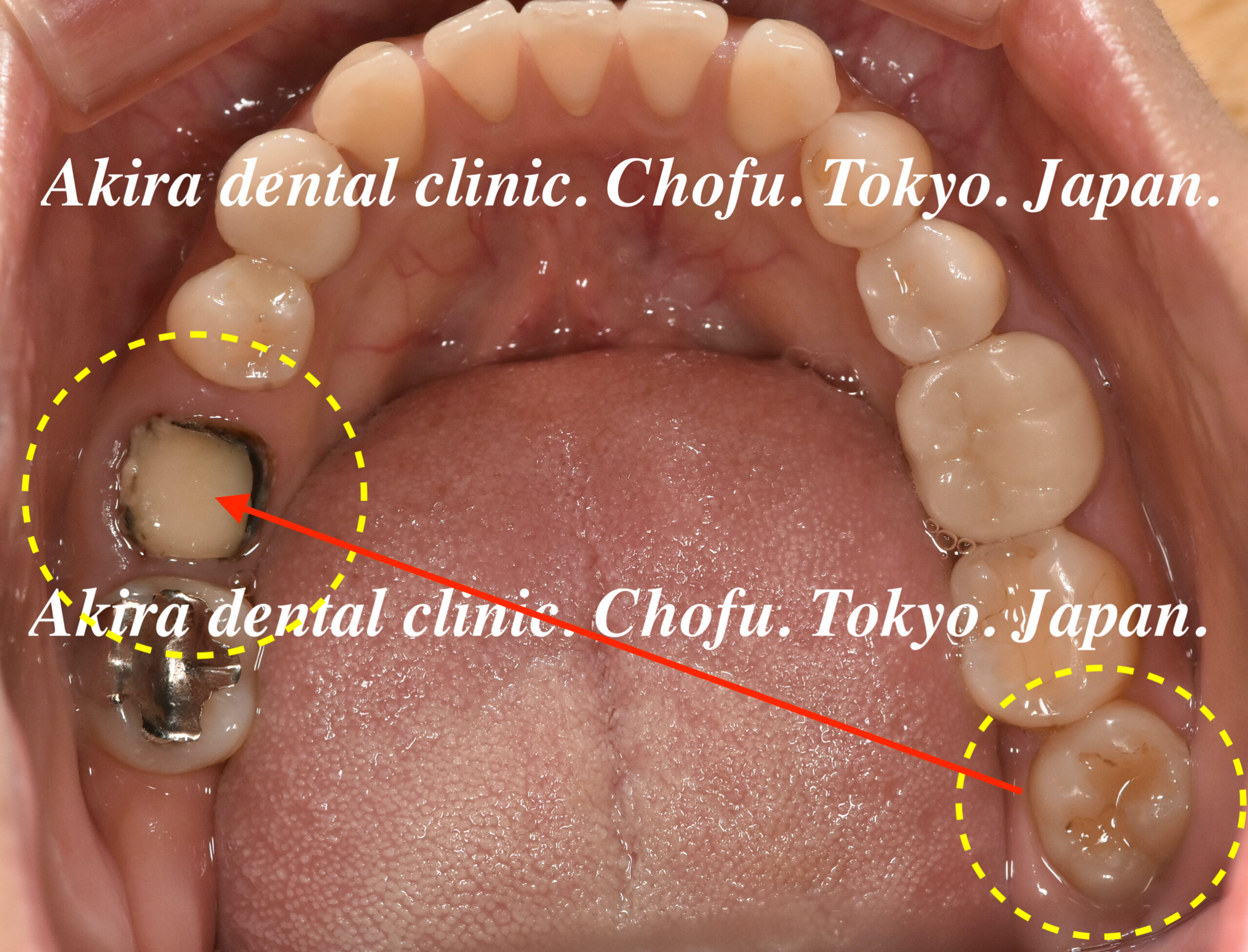 患者様の声 : 親知らず・歯の移植・自家歯牙移植編 Tooth 