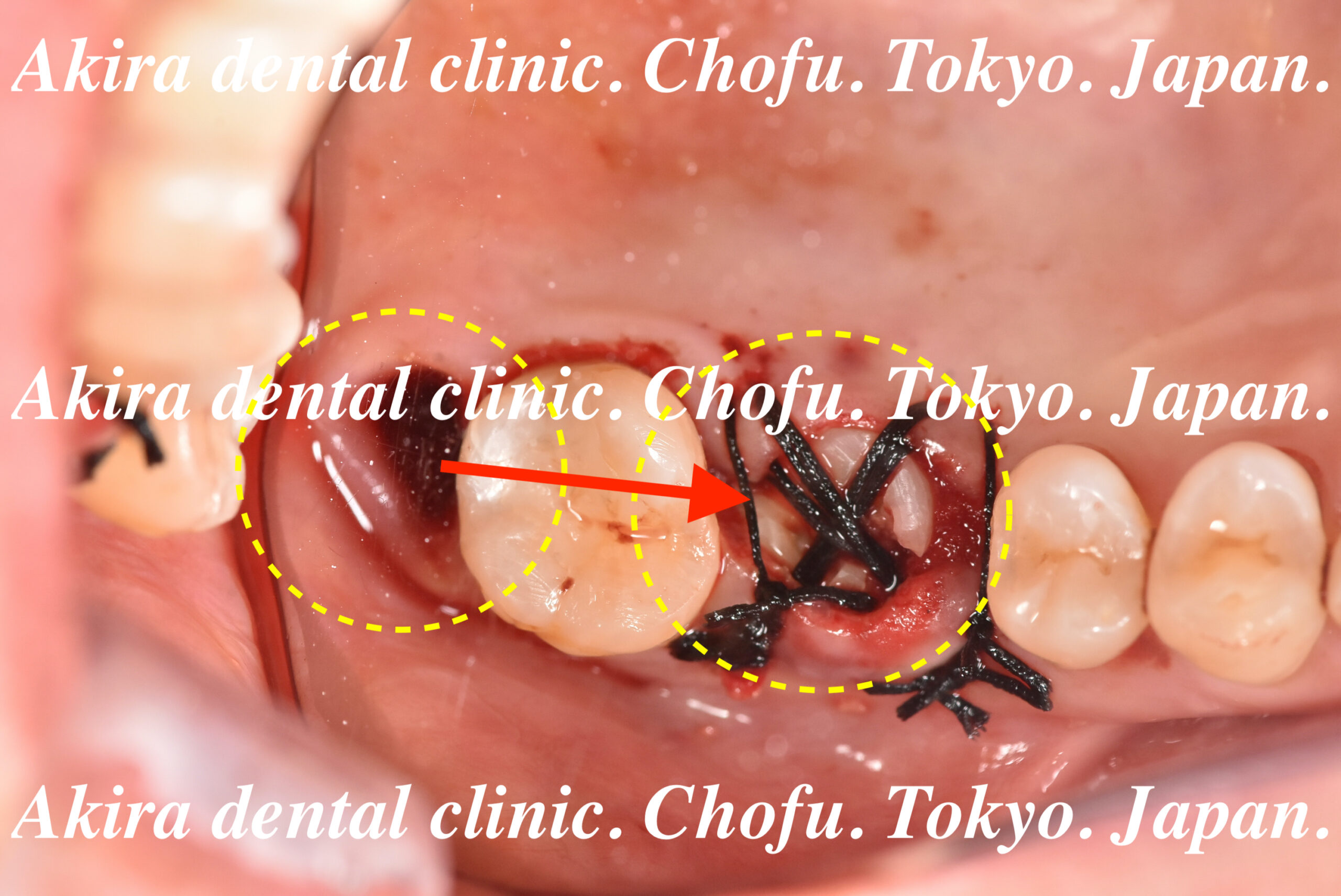 患者様の声 : 親知らず・歯の移植・自家歯牙移植編（上顎洞挙上術併用 